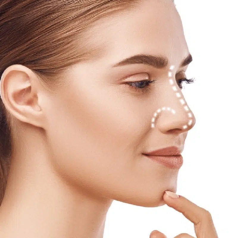 Rinplastia Dr Henry Sequeira